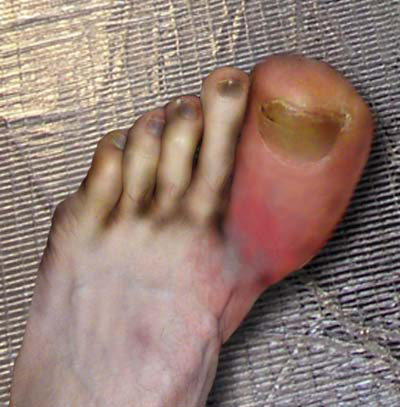 A dirty foot and a grossly enlarged big toe inflamed with gout.